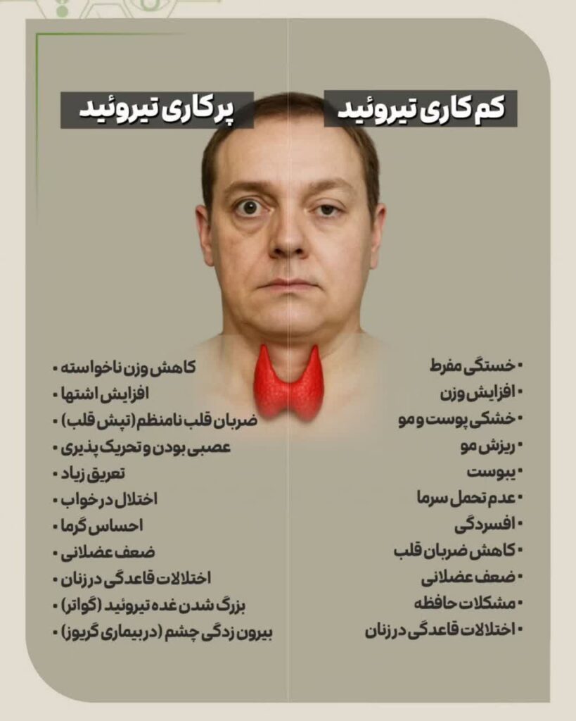 درمان تیروئید، علائم تیروئید